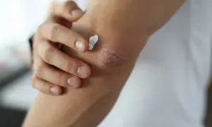 Eine Hand trägt Creme auf trockene Ellenbogen auf, um die Haut zu beruhigen.