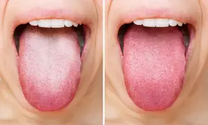 Vorher-Nachher-Vergleich: Eine belegte Zunge wird durch Hausmittel zur Zungenreinigung rosig und gesund.