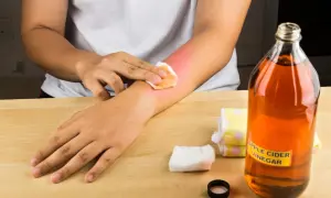 Person tupft mit Wattepad auf gerötete Haut am Arm. Daneben steht eine Flasche Apfelessig.