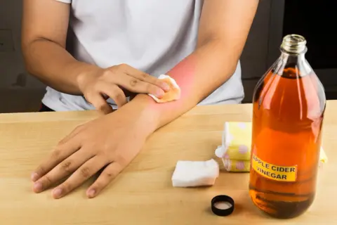 Person tupft mit Wattepad auf gerötete Haut am Arm. Daneben steht eine Flasche Apfelessig.