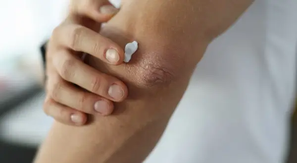 Eine Hand trägt Creme auf trockene Ellenbogen auf, um die Haut zu beruhigen.
