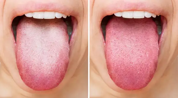 Vorher-Nachher-Vergleich: Eine belegte Zunge wird durch Hausmittel zur Zungenreinigung rosig und gesund.