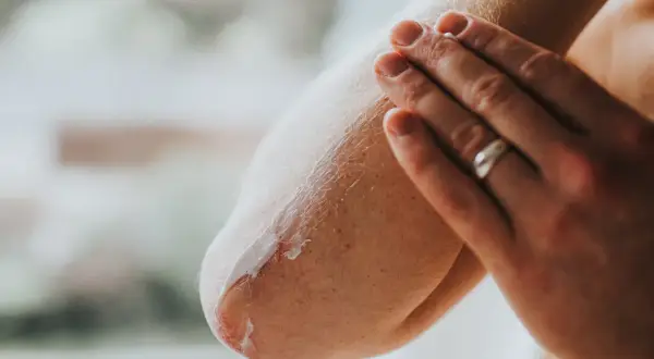 Hand cremt Ellenbogen ein, um trockene Haut zu pflegen. Die Haut ist gerötet und schuppig, die Creme spendet Feuchtigkeit.