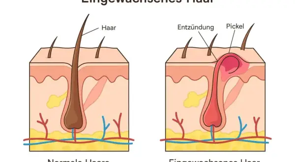 Vergleich von normalen Haaren und eingewachsenem Haar mit Entzündung und Pickel. So kann man eingewachsenes Haar entfernen.