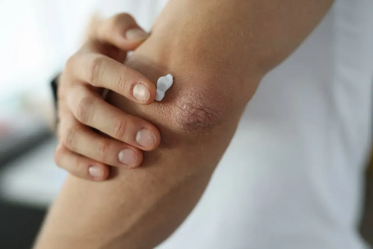 Eine Hand trägt Creme auf trockene Ellenbogen auf, um die Haut zu beruhigen.