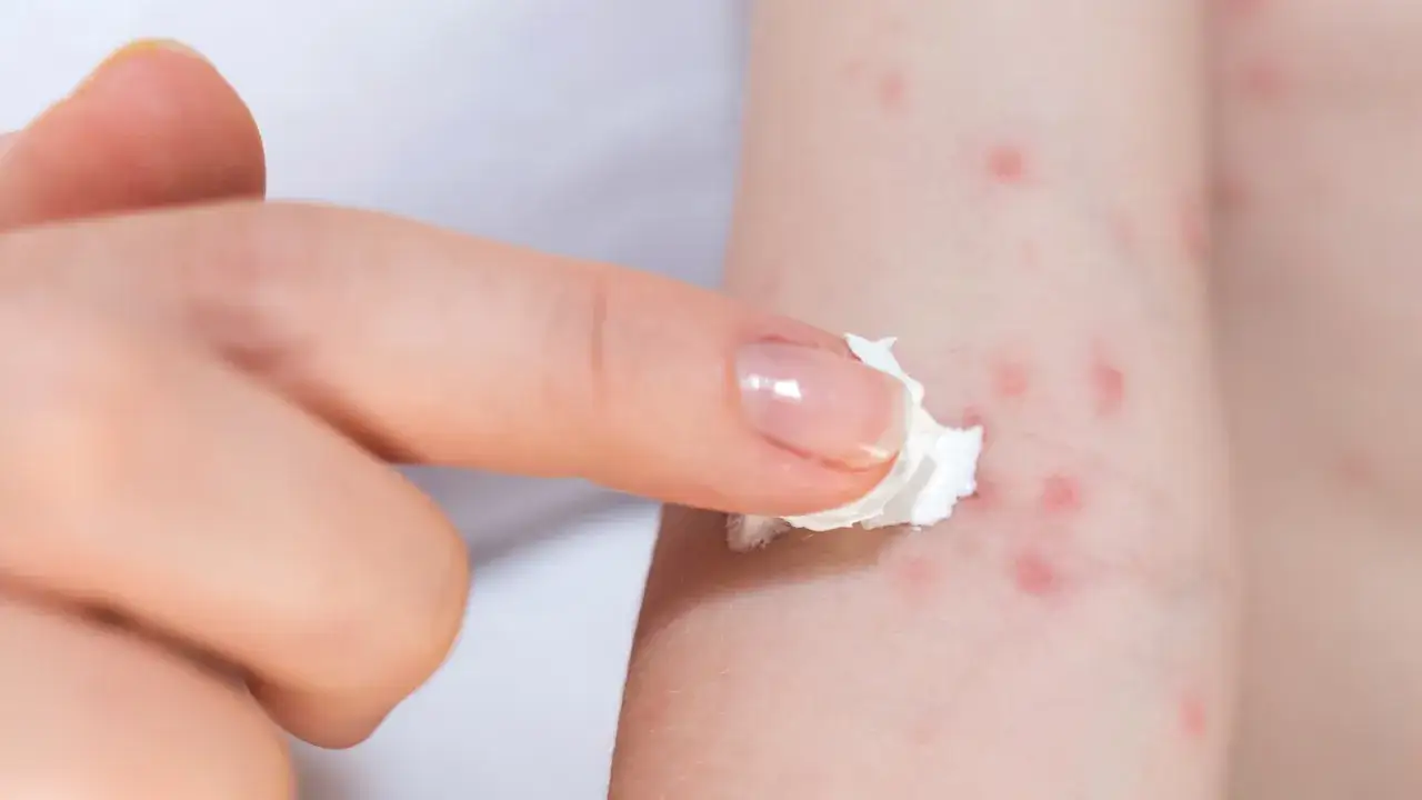 Finger with cream applies to red spots on skin, possibly due to hautreizung durch schwitzen. Hausmittel can help.
