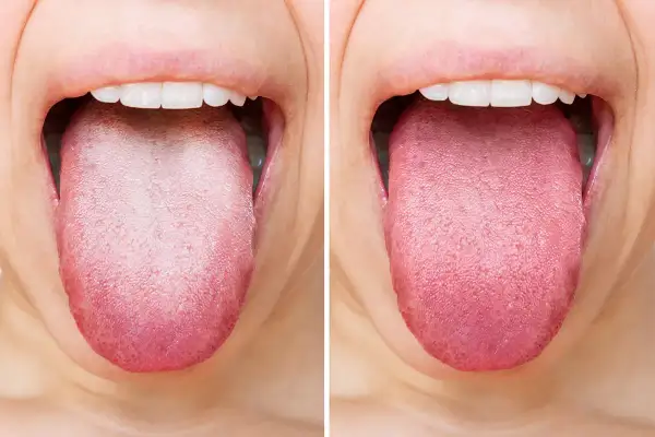 Vorher-Nachher-Vergleich: Eine belegte Zunge wird durch Hausmittel zur Zungenreinigung rosig und gesund.